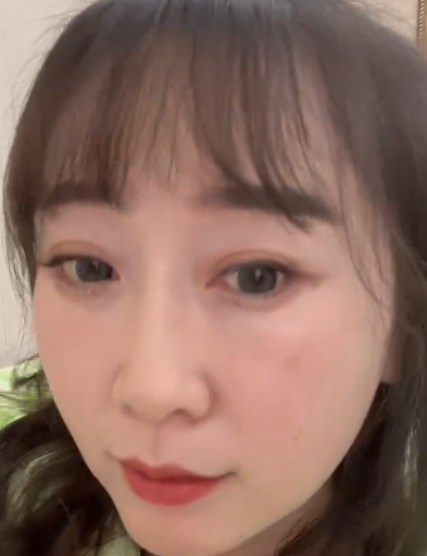 去眼袋手术
