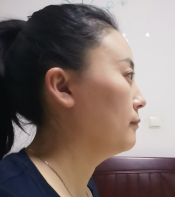 去眼袋手术