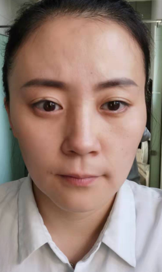 去眼袋手术