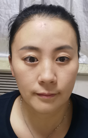 去眼袋手术