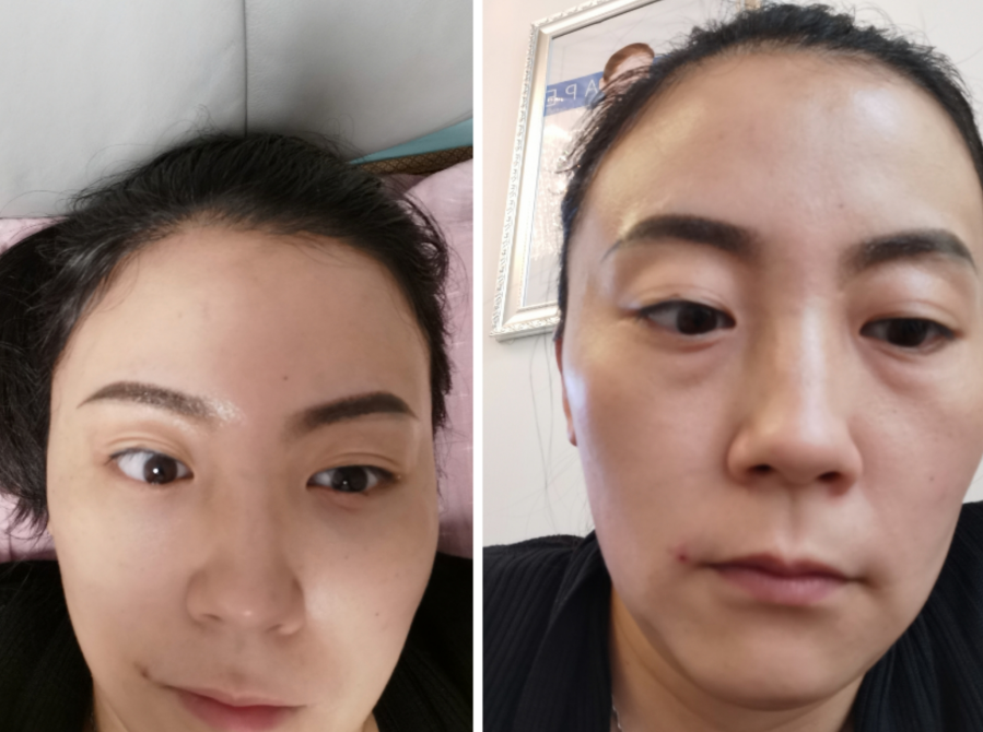 去眼袋手术