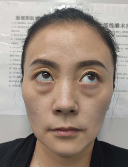 去眼袋手术