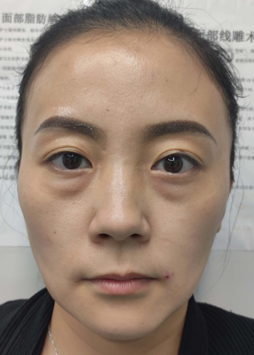 去眼袋手术