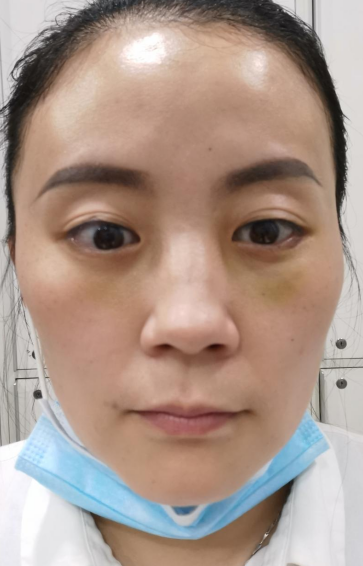 去眼袋手术