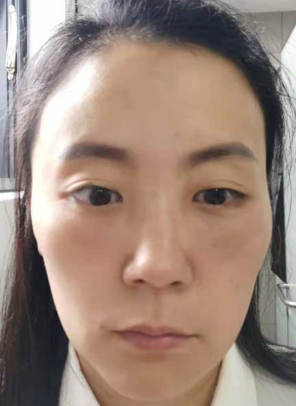 去眼袋手术