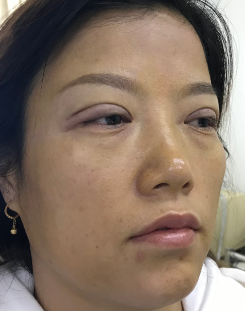 去眼袋手术