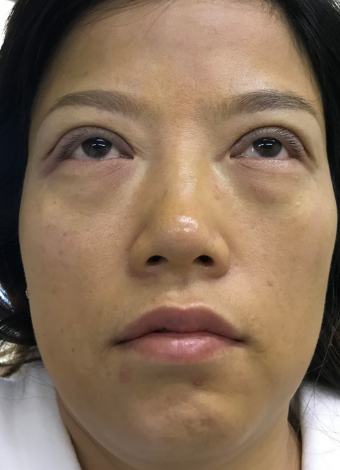去眼袋手术