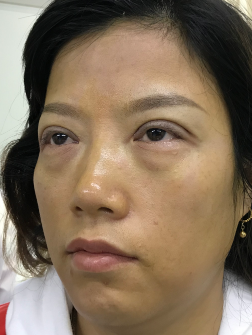 去眼袋手术