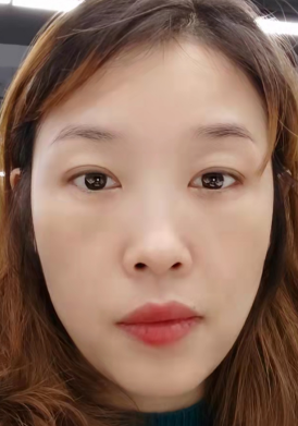去眼袋手术