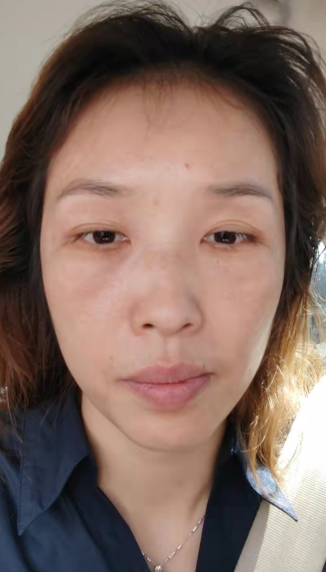 去眼袋手术