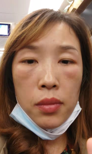 去眼袋手术