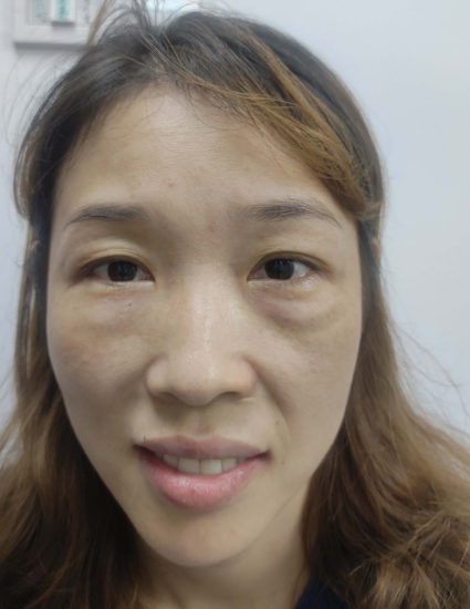 去眼袋手术
