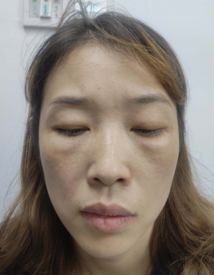 去眼袋手术