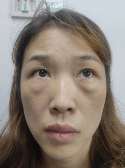 去眼袋手术