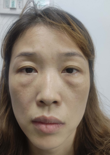 去眼袋手术