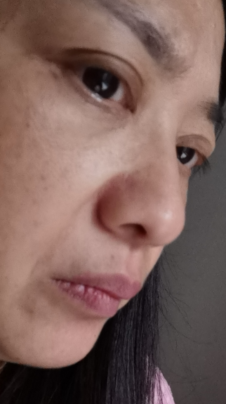 去眼袋手术