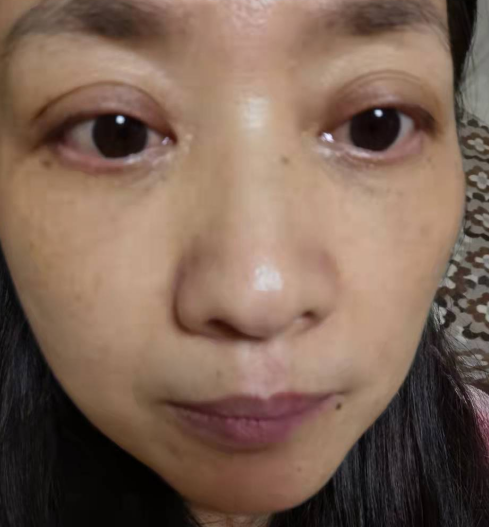 去眼袋手术