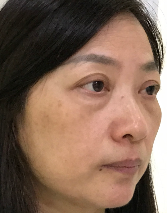 去眼袋手术