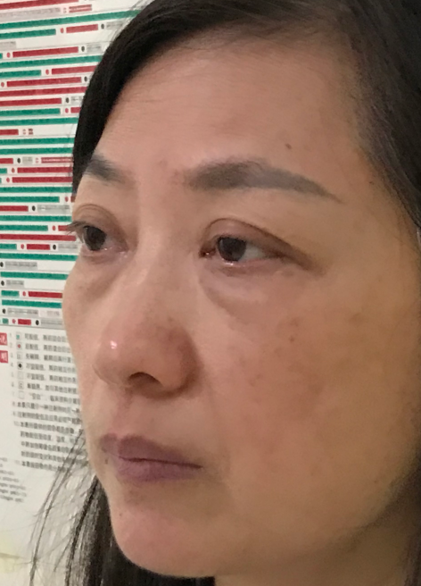去眼袋手术