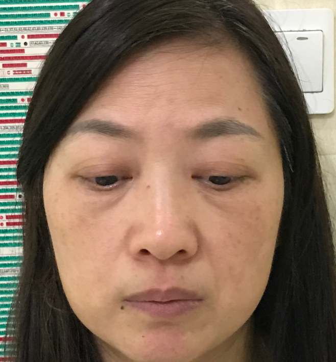去眼袋手术