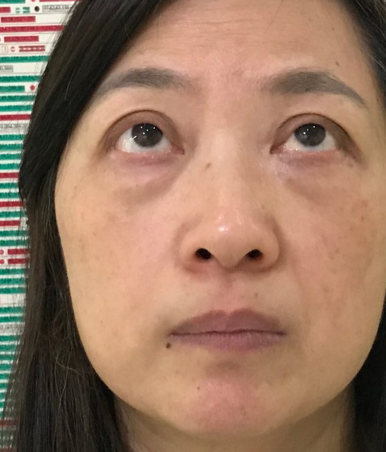 去眼袋手术