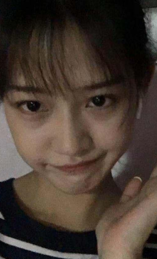去眼袋手术