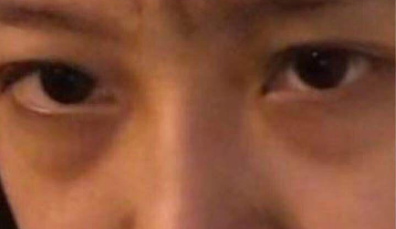 去眼袋手术