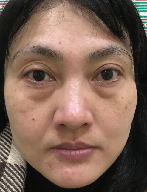 去眼袋手术