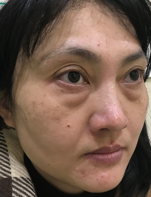 去眼袋手术