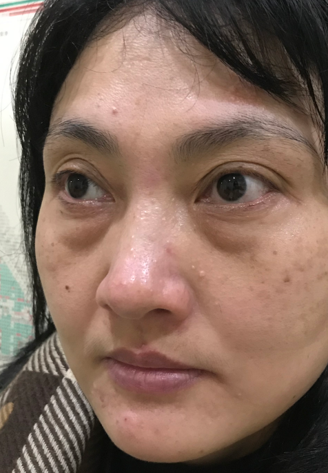 去眼袋手术