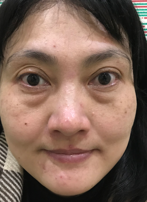 去眼袋手术