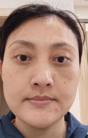 去眼袋手术