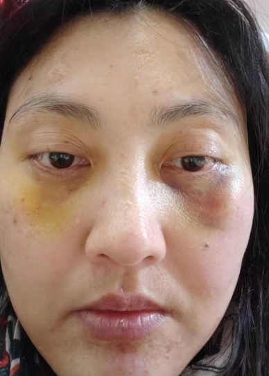 去眼袋手术