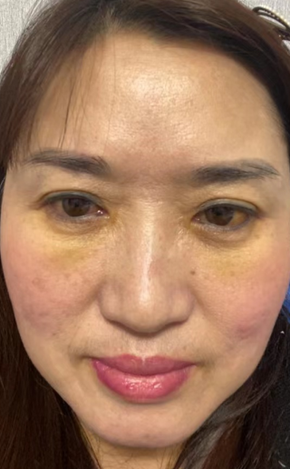 去眼袋手术
