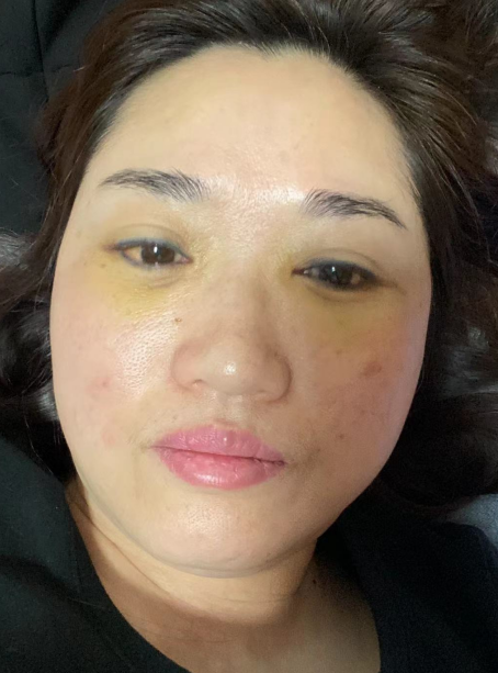 去眼袋手术