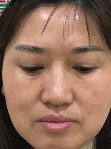 去眼袋手术