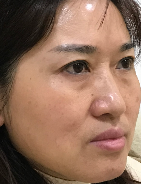 去眼袋手术