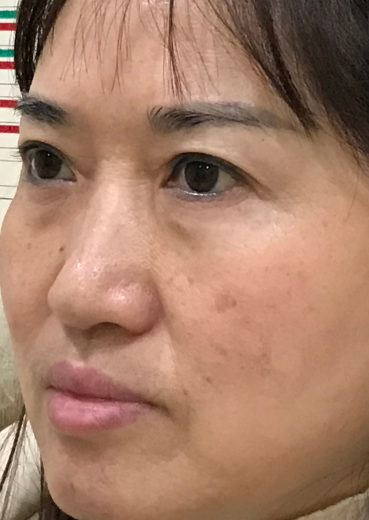 去眼袋手术