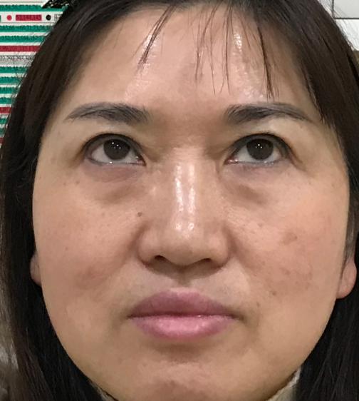 去眼袋手术