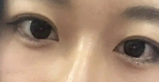 去眼袋手术