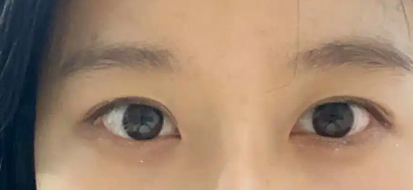 去眼袋手术