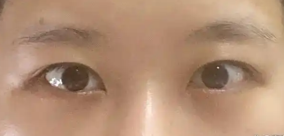去眼袋手术