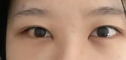 去眼袋手术