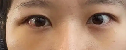 去眼袋手术