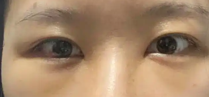 去眼袋手术