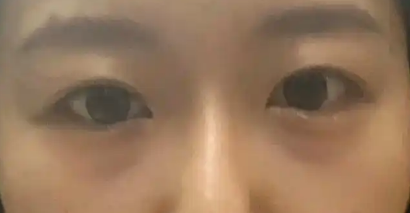 去眼袋手术