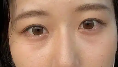 去眼袋手术
