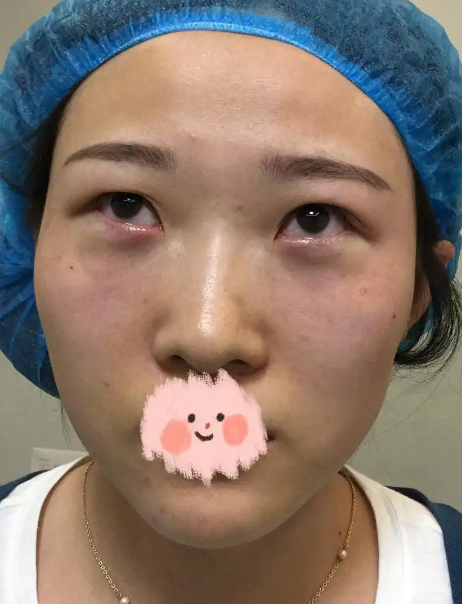 去眼袋手术