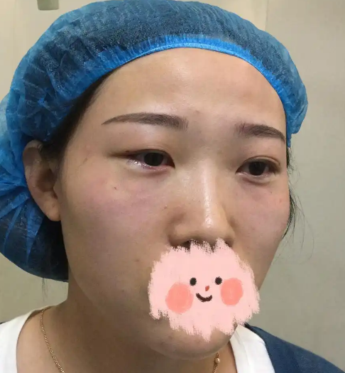去眼袋手术