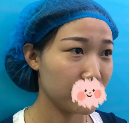 去眼袋手术